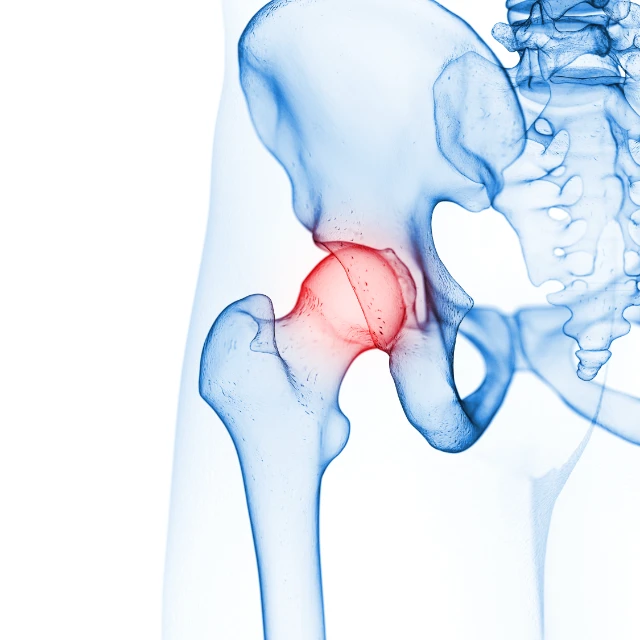 服務分類 - 髖關節