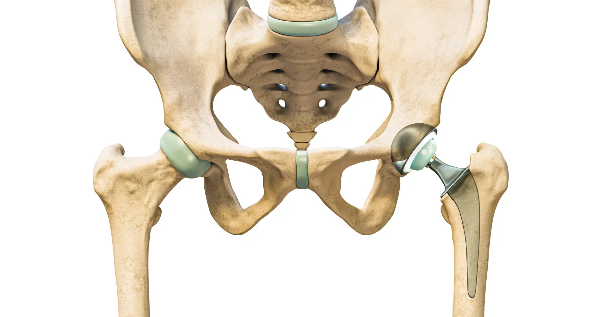 正前位人工髖關節置換&髖關節翻修手術